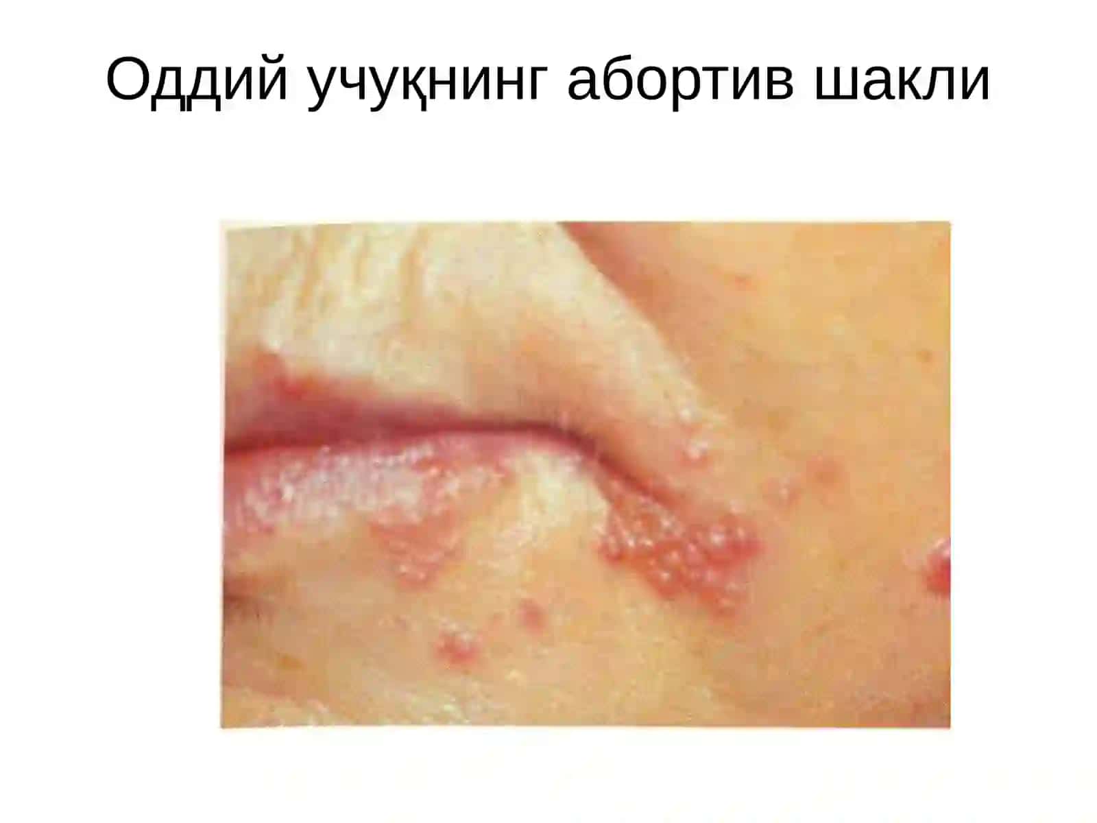 Терининг вирусли касалликлари 4