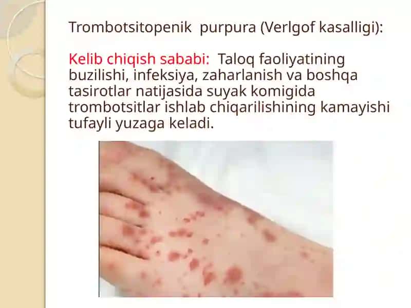 Gemorragik diatezlarning ko’rinishlari 4