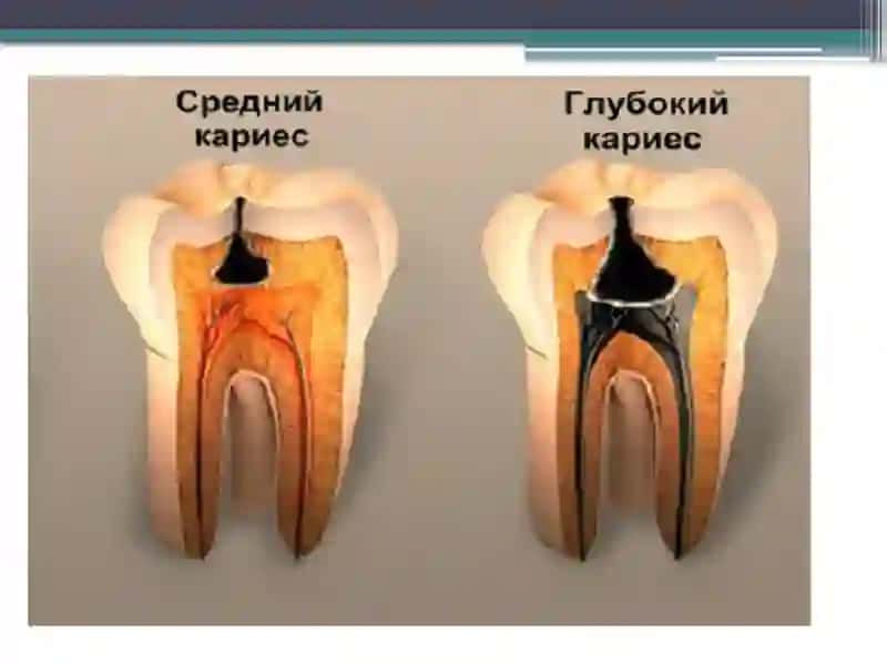 CHUQUR KARIESNI QIYOSIY TASHXISLASH 4
