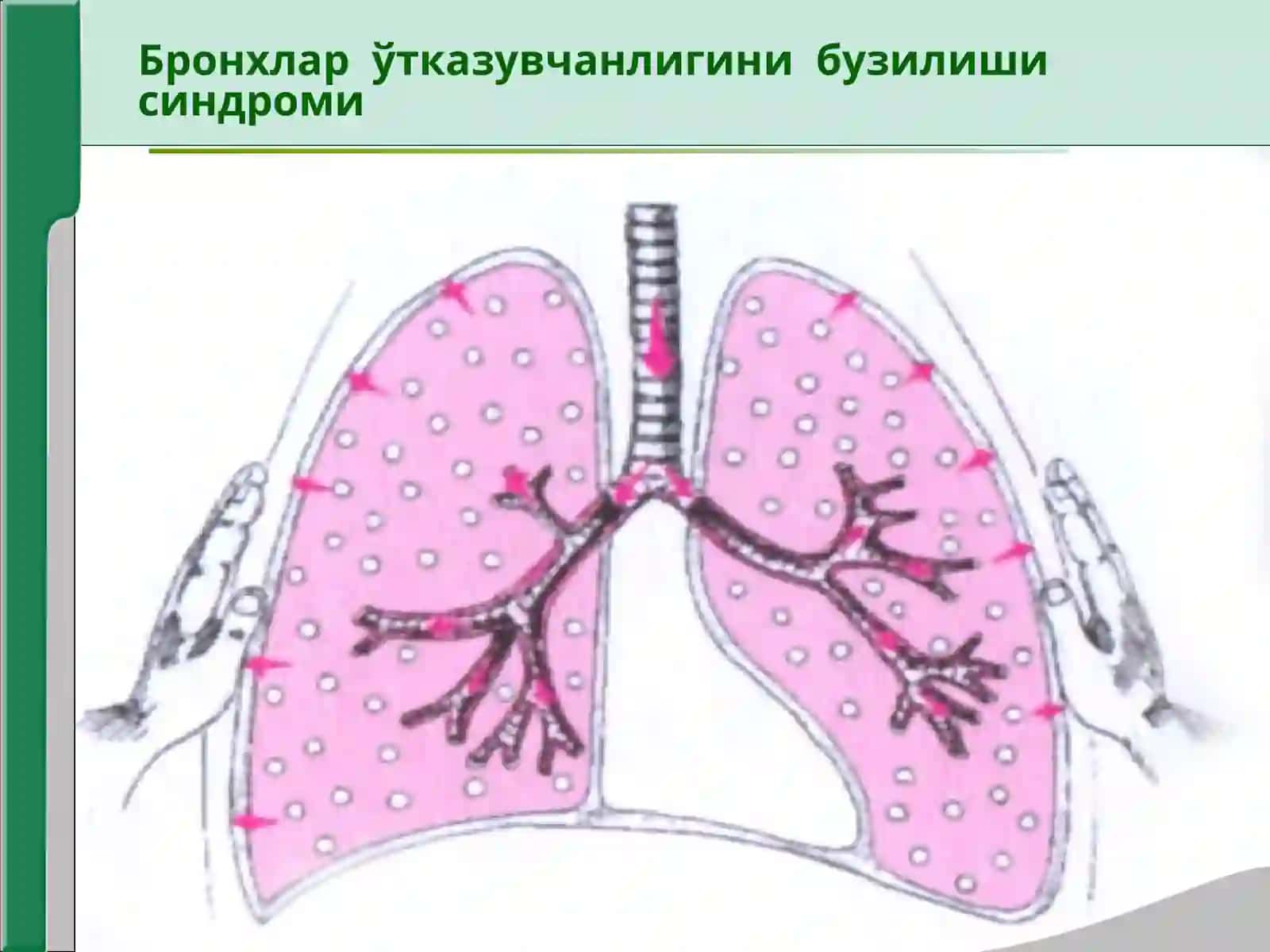 Нафас органлари касалликларида асосий клиник синдромлар 4