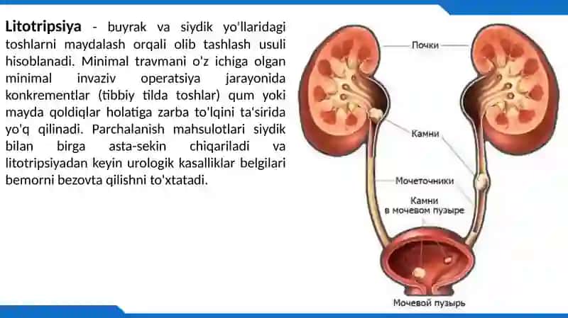 LitotripsiyaApparatlari 4
