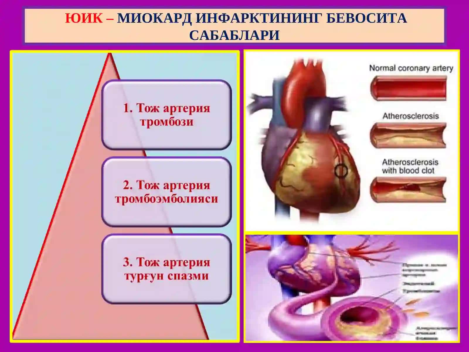 Юрак ишемик касаллиги 4
