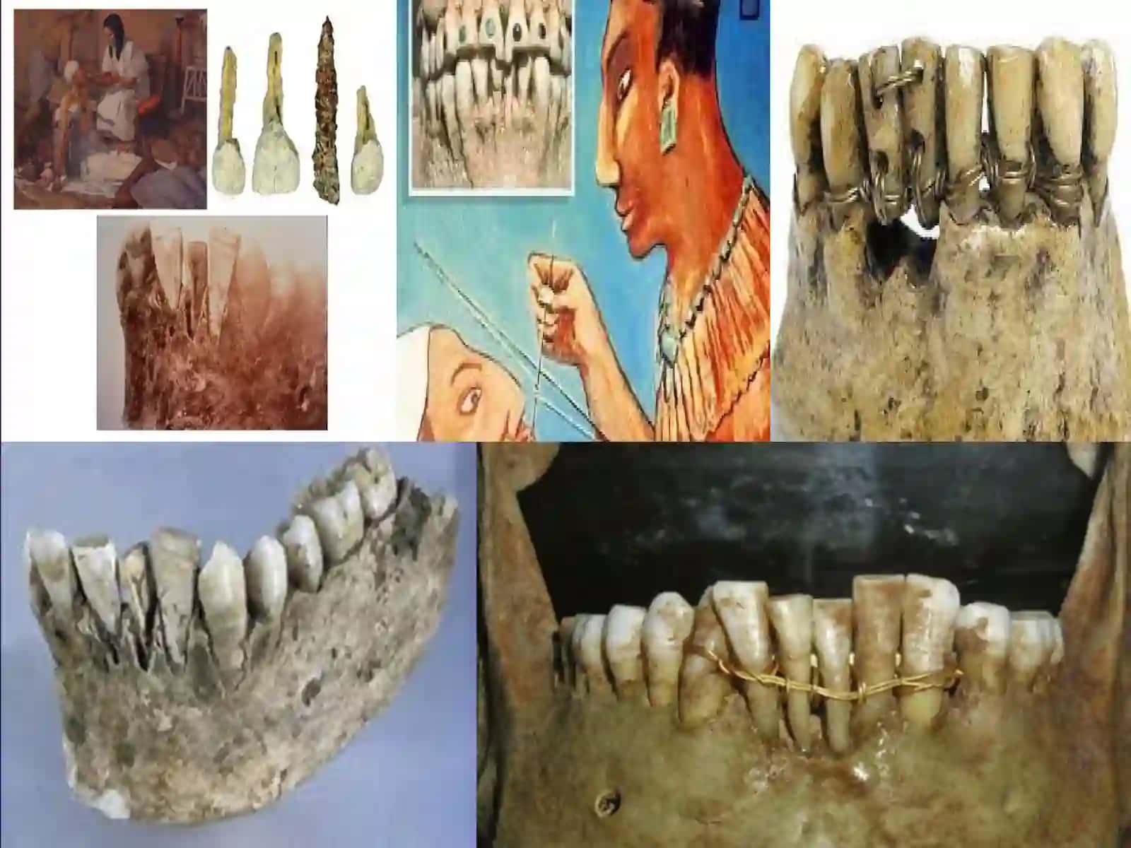 Имплантация тарихи 4