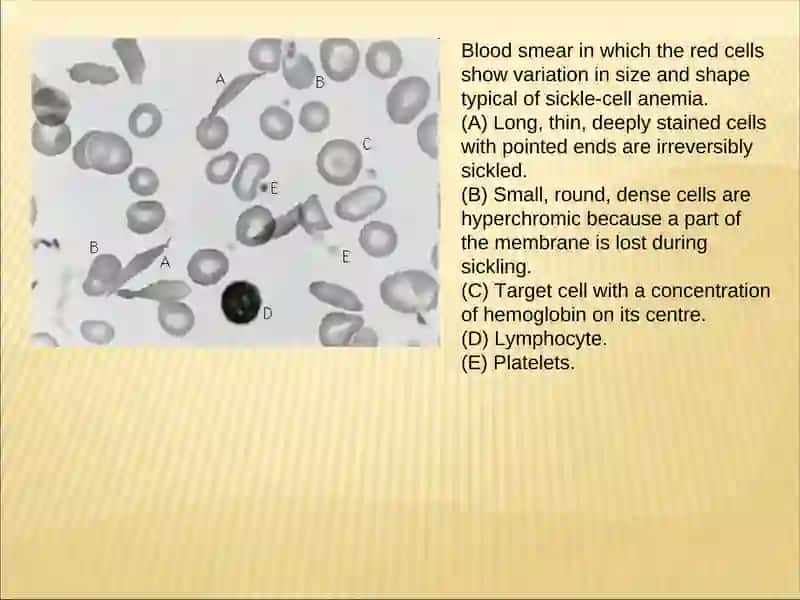 Blood smear analysis for sickle-cell anemia 4