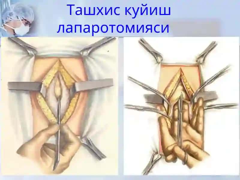 Xirurgik operatsiyalar 4