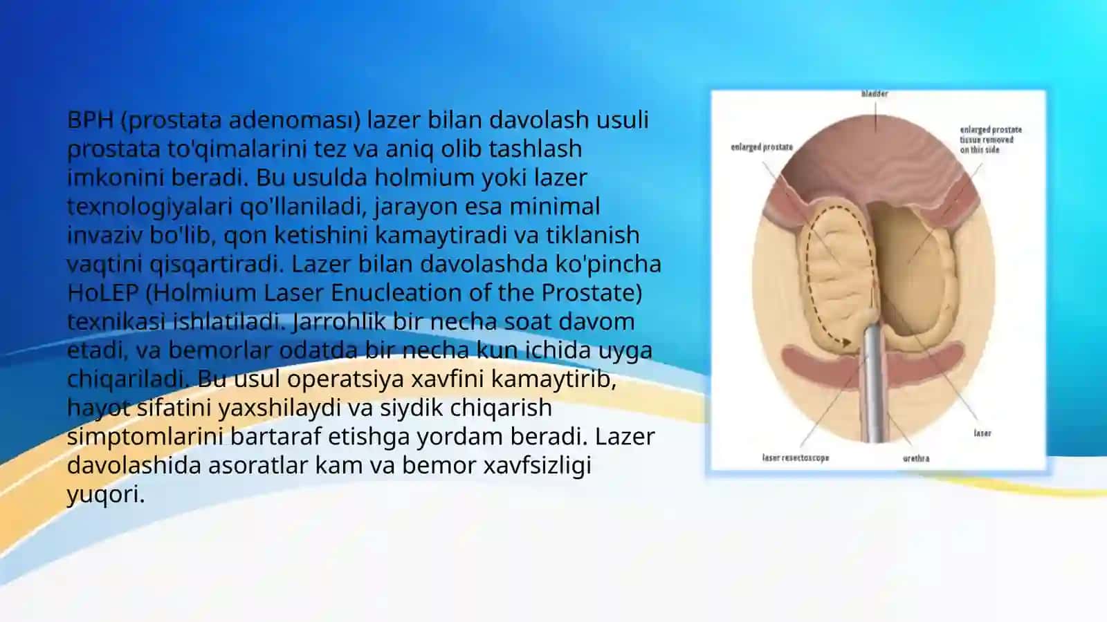Urologiyada lazer xirurgiyasi 4