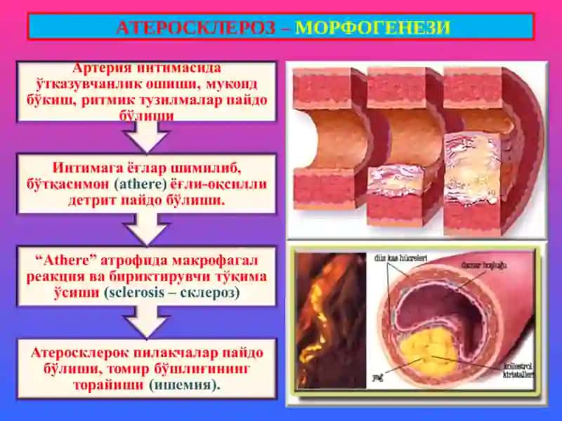 Атеросклероз. Гипертония касаллиги 4