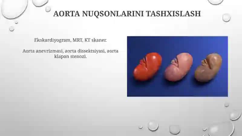 Aortal nuqsonlar simptomatologiyasi 4
