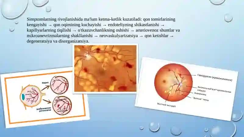 Diabetik retinopatiya 4