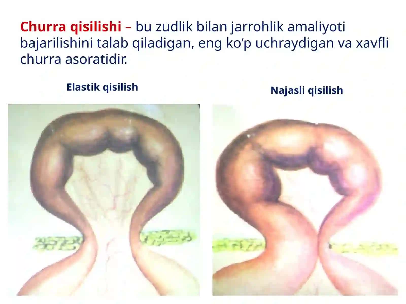 Qorin tashqi churralari va ularning asoratlari 4