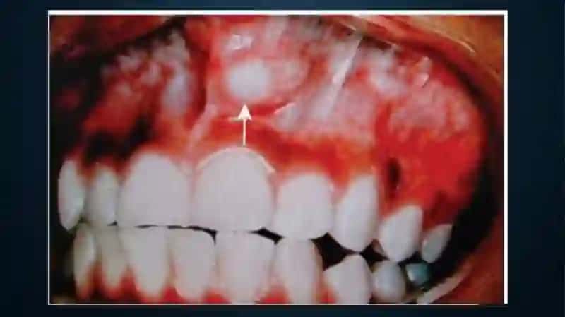 SO’LAK BEZLARI O’SMALARI. MONOMORF ADENOMA, POLIMORF ADENOMA, MUKOEPIDERMOID O’SMA 4