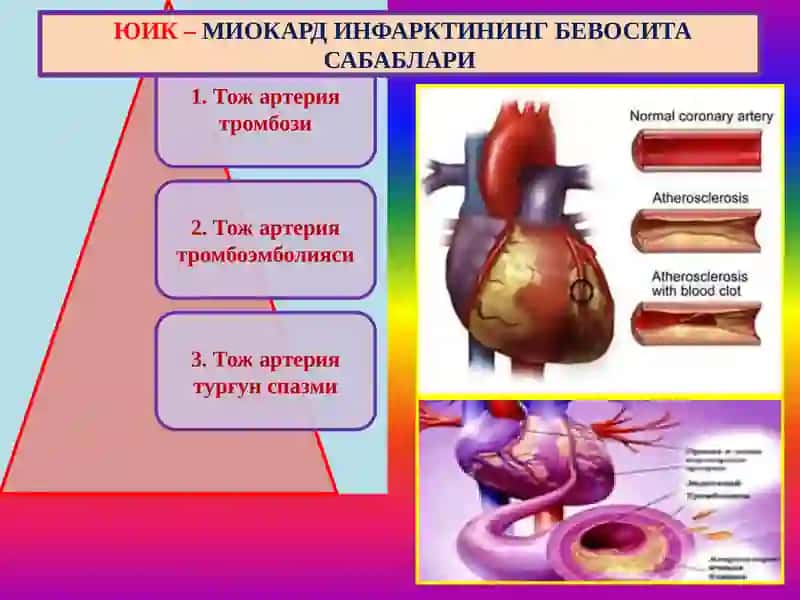 Юрак ишемик касаллиги. Цереброваскуляр касаллик 4