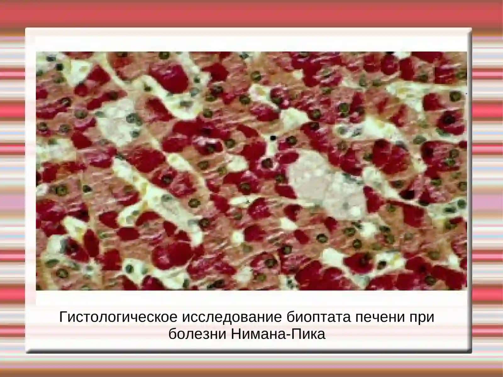 Болезнь Ниманна-Пика 4