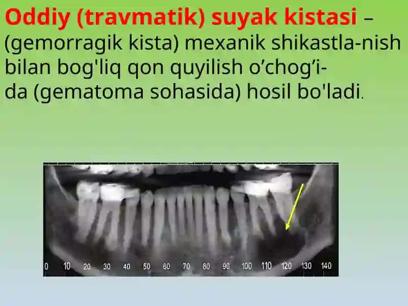 Anevrizmal suyak kistasi (ASK) 4