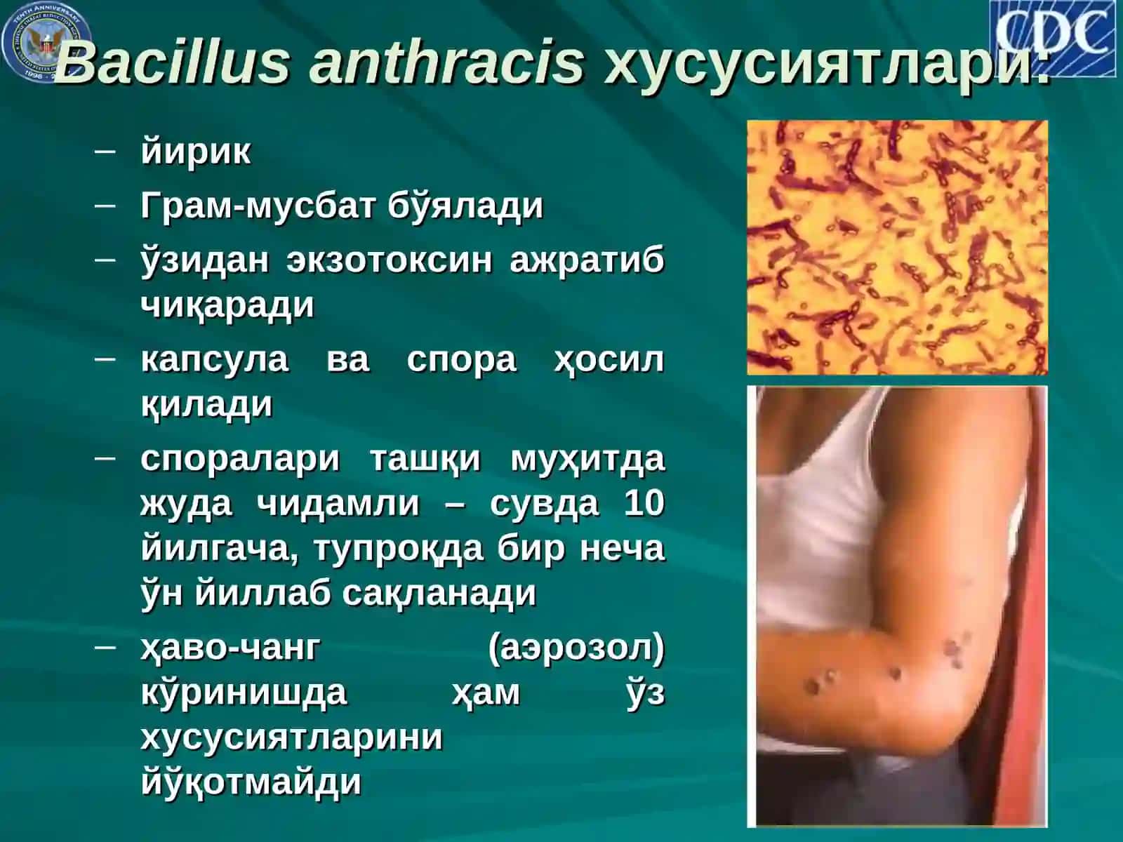Куйдирги (сибир яраси, ёмон сифатли карбункул) 4