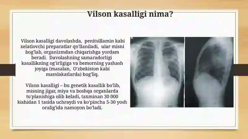 Vilson-Kanovalov kasalligi 4