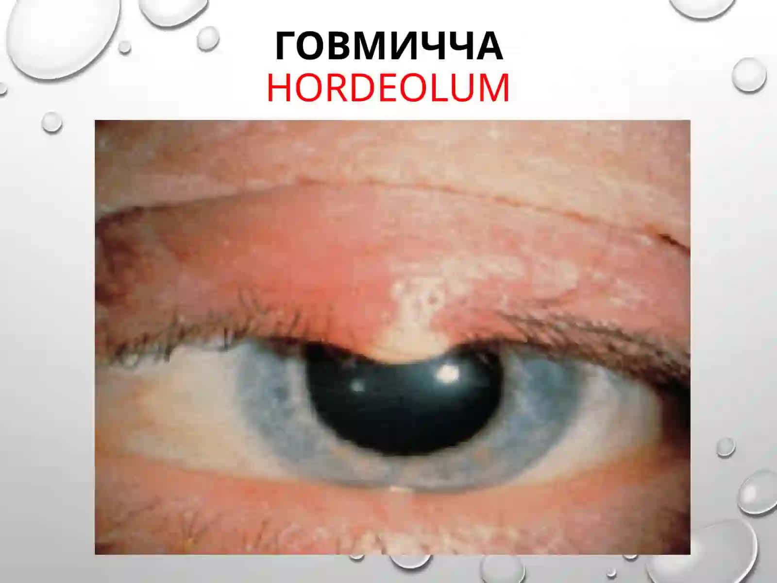 кўзнинг яллиғланиш касалликлари 4