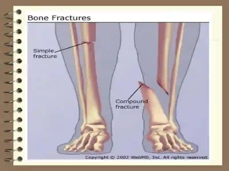 FRACTURES 4