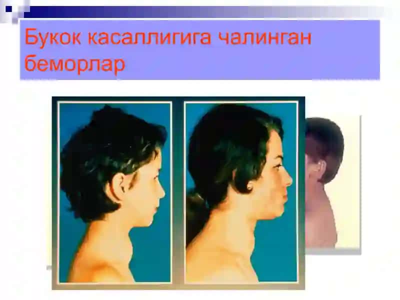 Йод етишмовчилиги ва унинг зарарли окибатлари 4