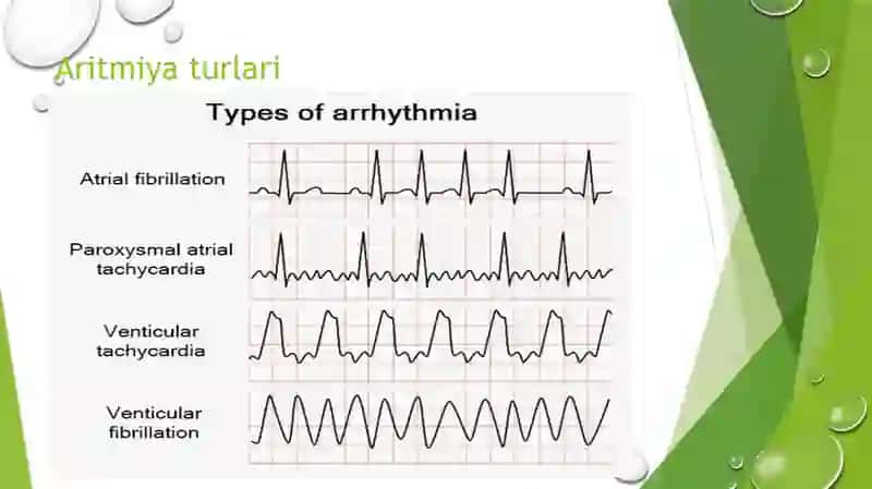 Yurak aritmiyalari EKG diagnostikasi 4