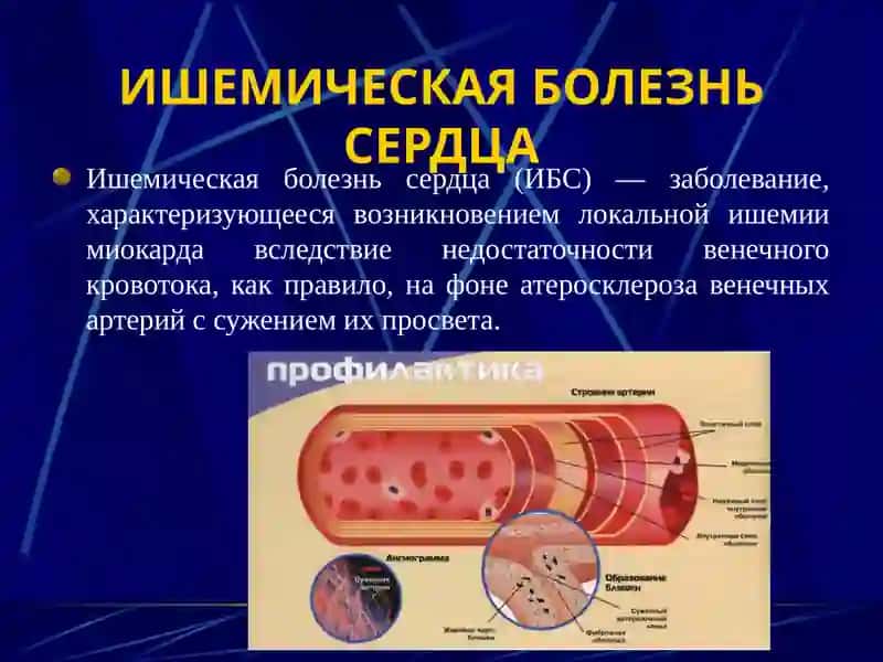 Ишемическая болезнь сердца 4