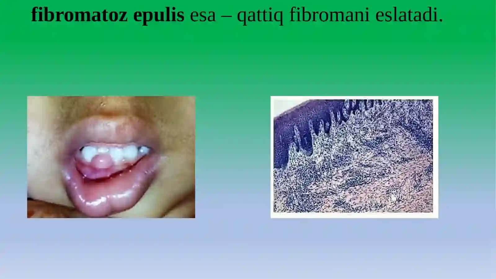 EPULIS (MILK USTI XOSILASI) 4