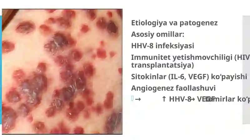 Kaposhining sarkomasi. Ekzema Kaposhi.IFAva PZR diagnostik usullarining dermatovenerologiyada qoʻlla 4