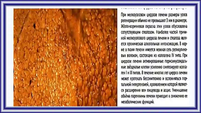 ПАТОЛОГИЯ ПЕЧЕНИ И ЖЕЛЧЕВЫВОДЯЩИХ ПУТЕЙ 4