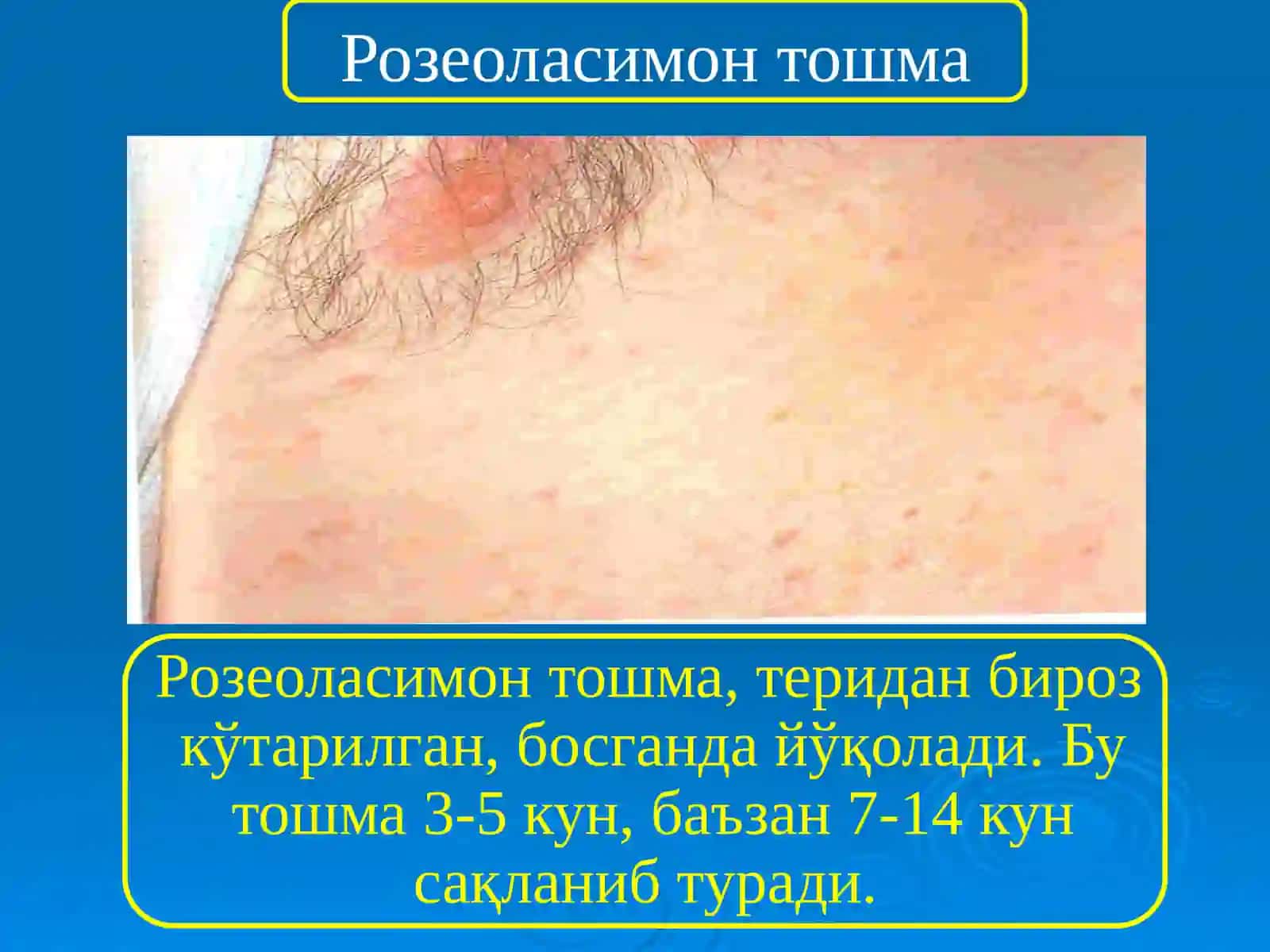 ТИФ-ПАРАТИФ КАСАЛЛИКЛАРИ 4