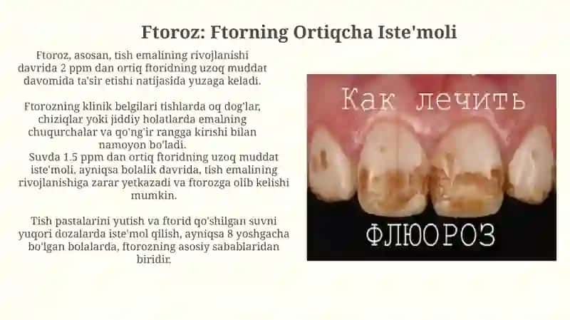Mikroelementoz kalsiy va ftor miqdori oshib ketishi 4