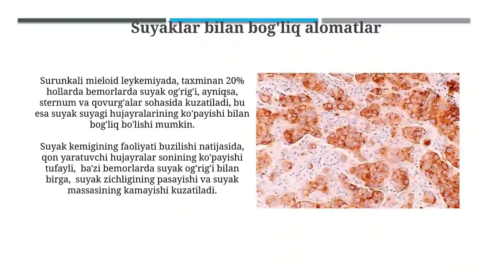 Surunkali mieloleykoz simptomatologiyasi 4