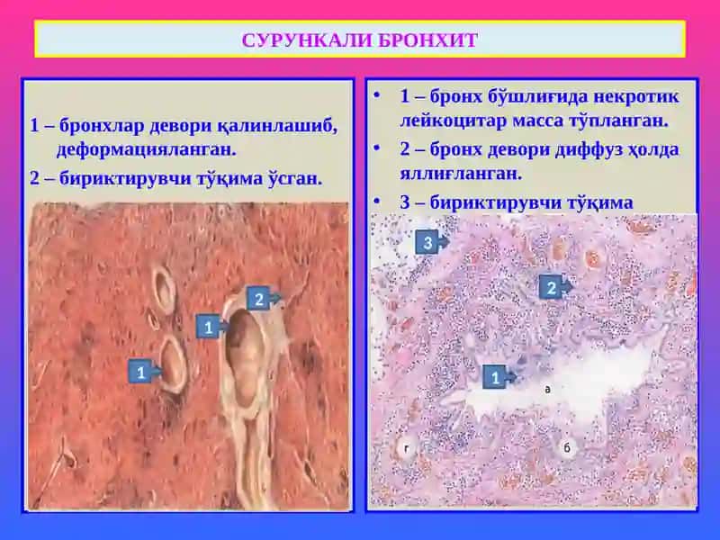 ПАТОЛОГИК АНАТОМИЯ “Ўпка касалликлари” 4