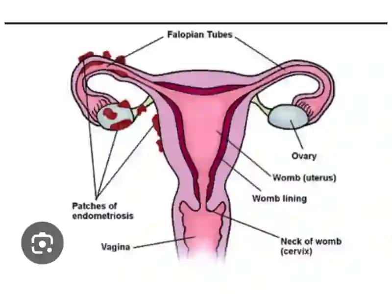 Endometrioz-bachadonshilliq 4