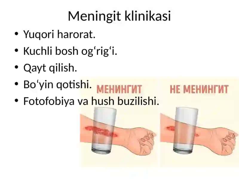 MNS ning yuqumli kasalliklari: meningit, ensefalit 4