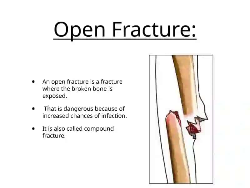 Fractures 4