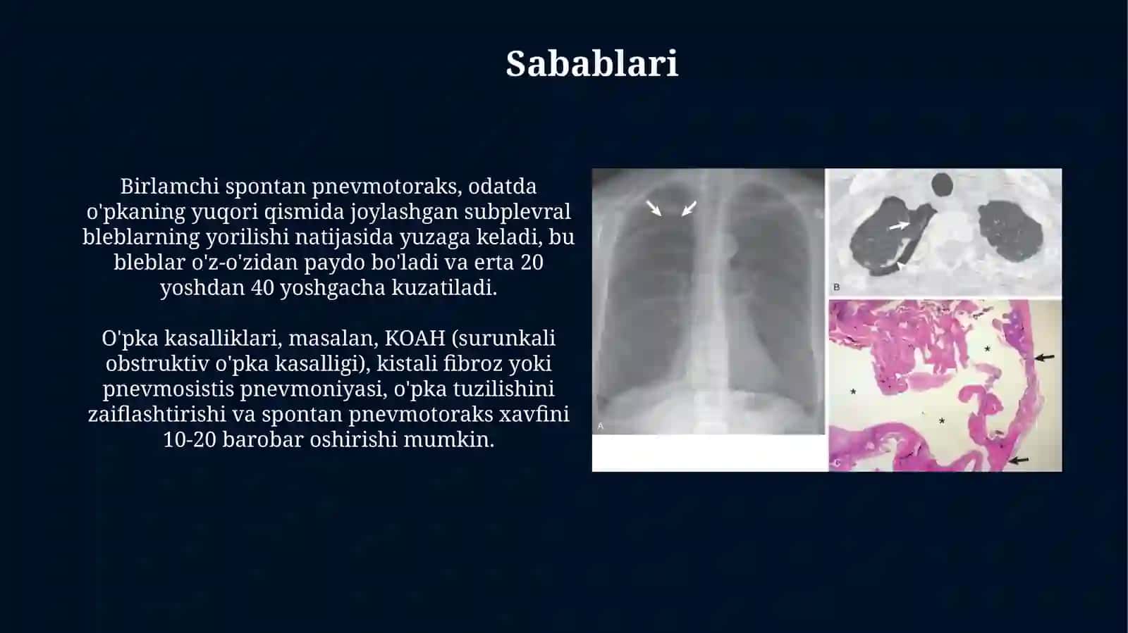 Spontan Pnevmotoroks 4