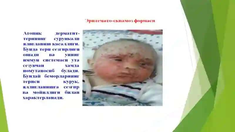 ATOPIK DERMATIT 4
