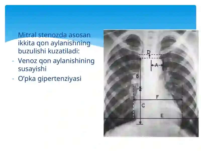 YURAKNING MITRAL POROGI VA STENOZI 4