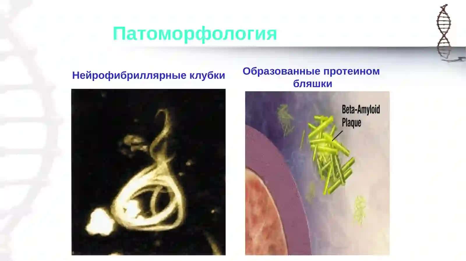 Болезнь Альцгеймера 4