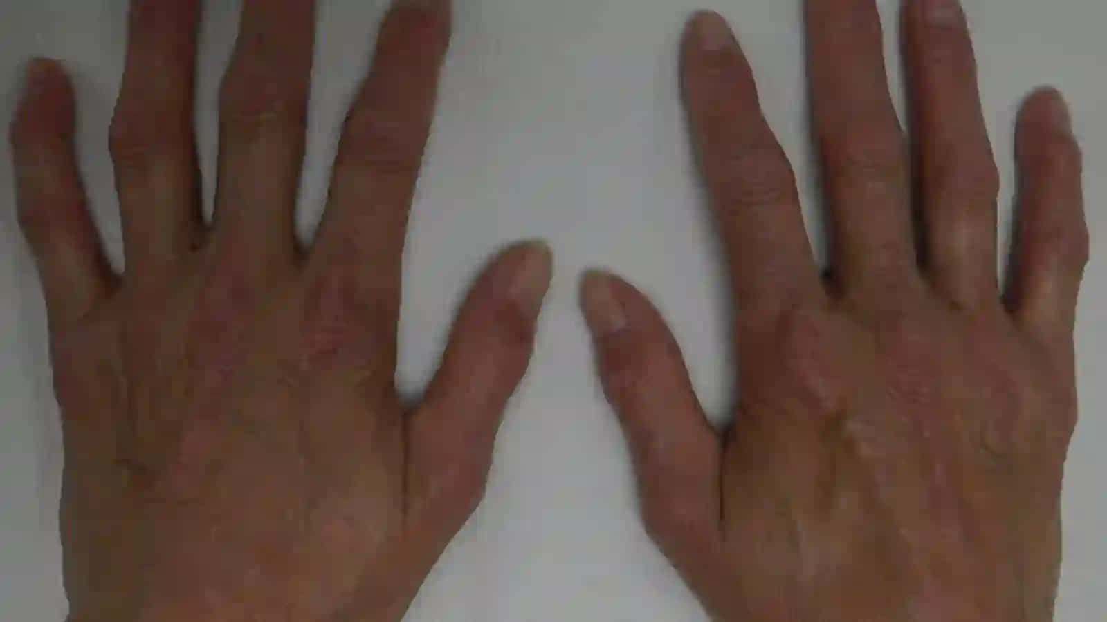 SKLERODERMIYA. DERMATOMIOZIT 4