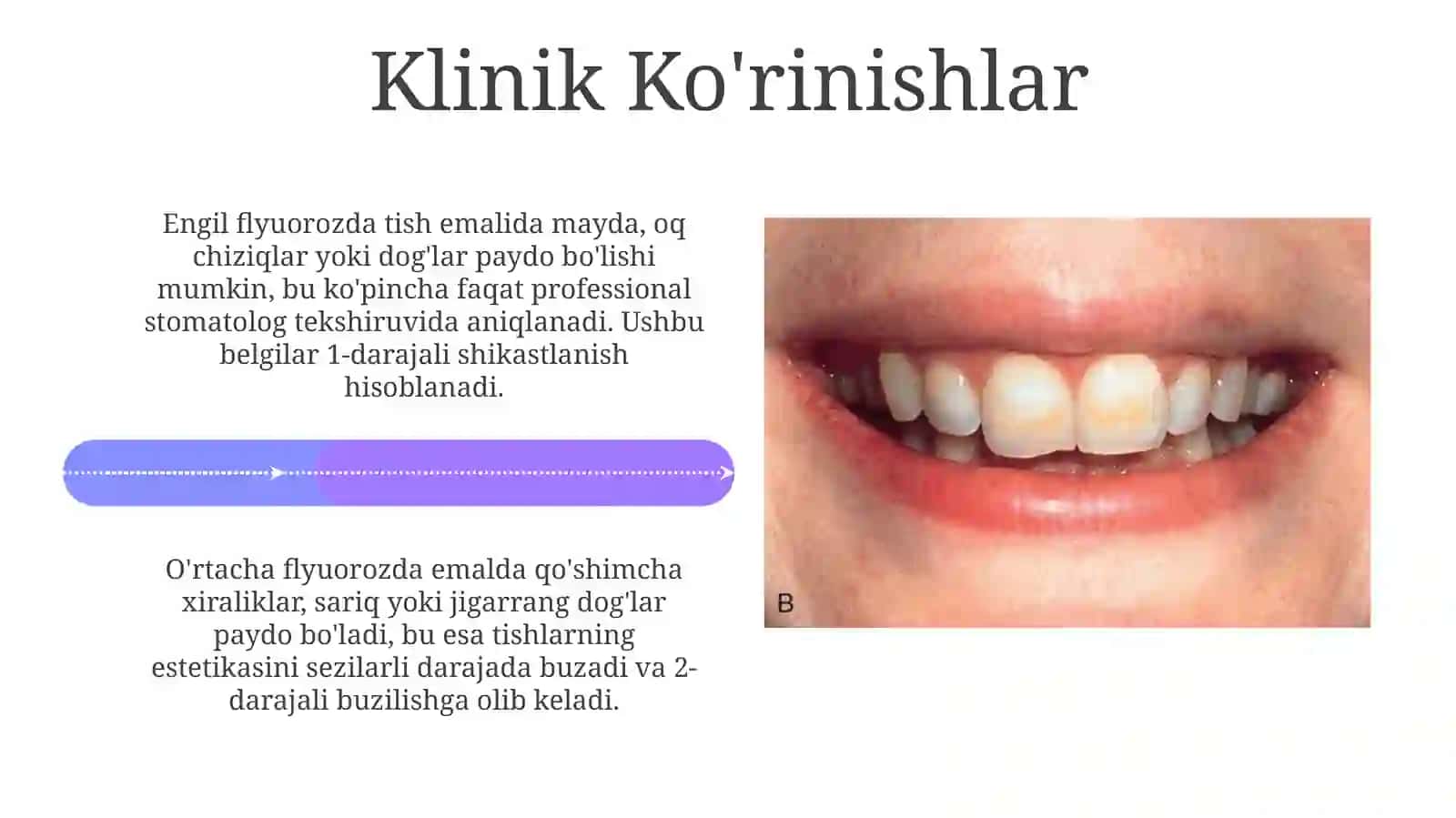 Endemik flyuorozning asoratlari 4