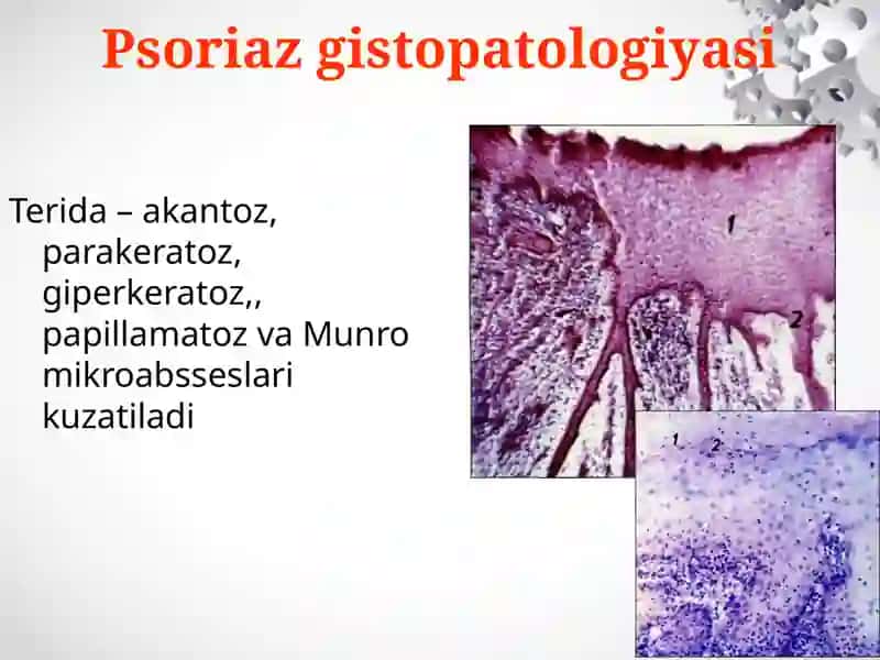 PSORIAZvaQIZIL YASSI TEMIRATKININGATIPIK TURLARI 4