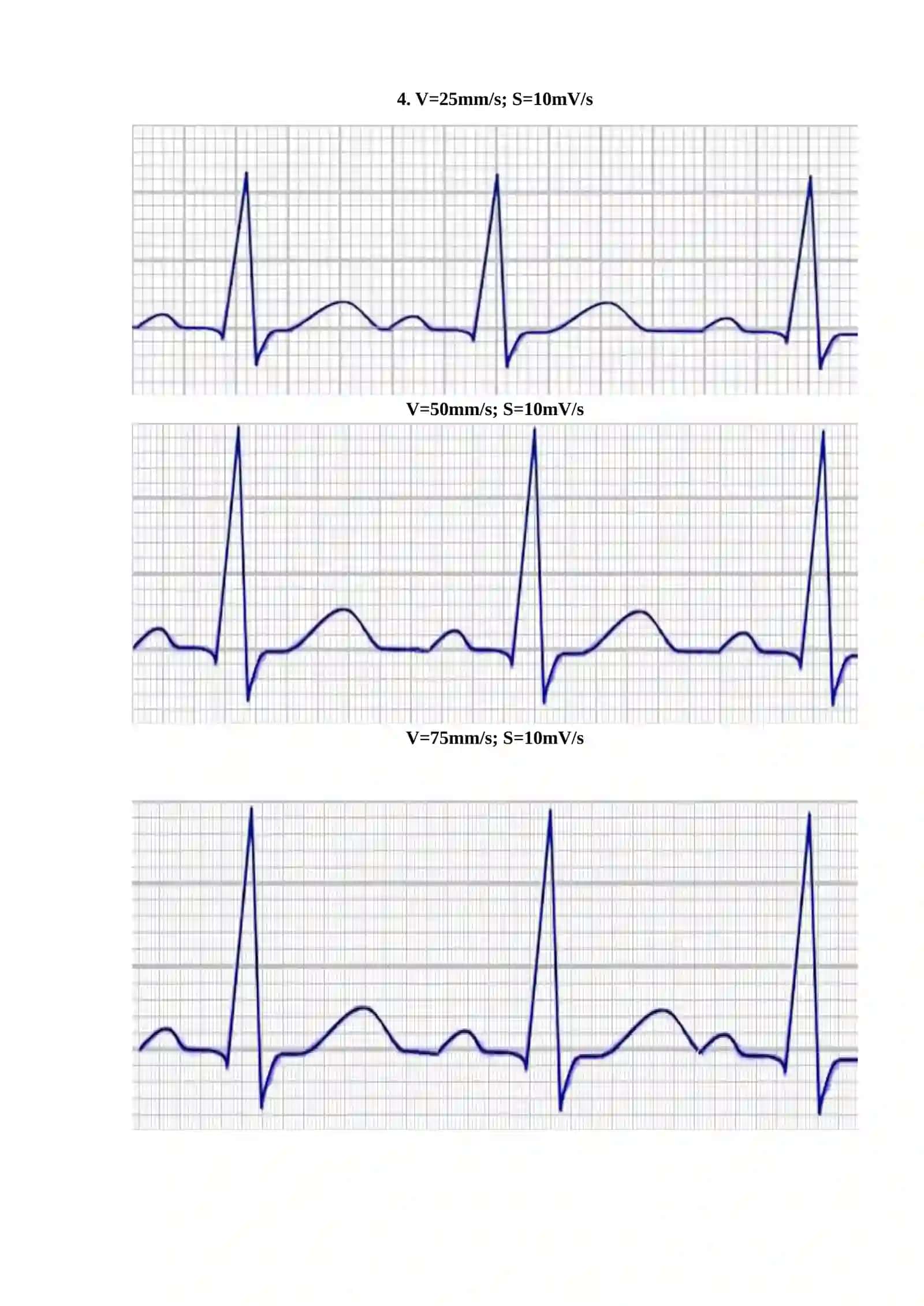 V=25mm/s; S=10mV/s 4