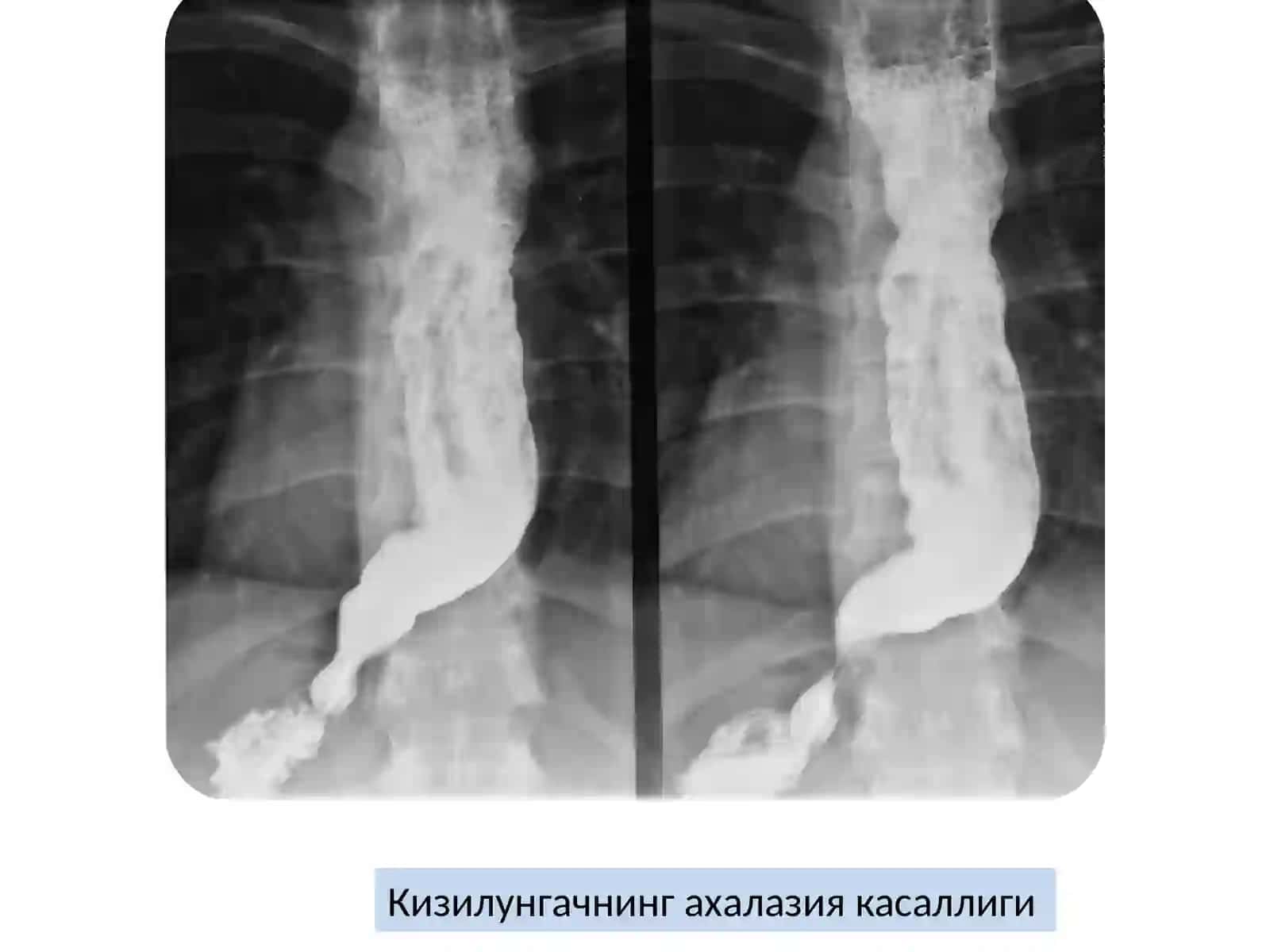 Hazm yo'llari kasalliklarida nur tashxislash  diagnostikasi 4