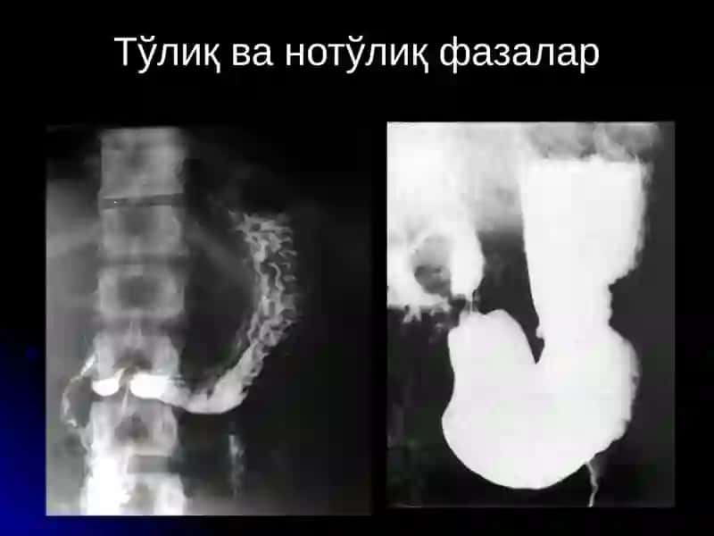ОШКОЗОН-ИЧАК КАСАЛЛИКЛАРИ НУР ТАШХИСИ 4