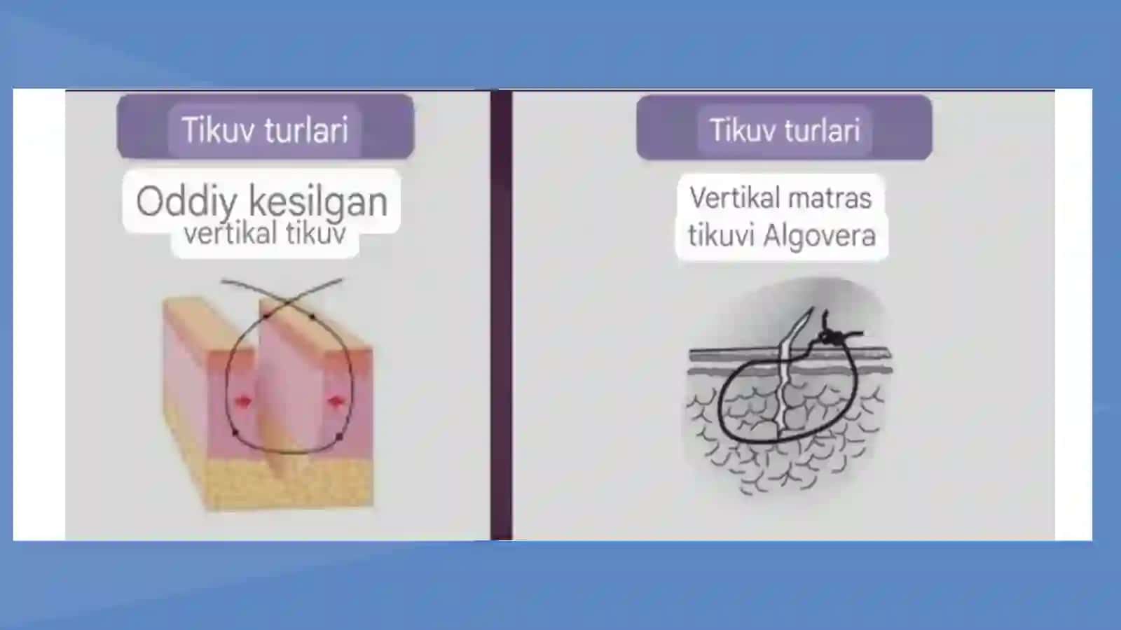 PASTKI JAG’DA IMPLANTATSIYA 4
