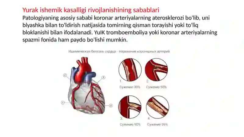 Yurak Ishemik Kasalligi 4