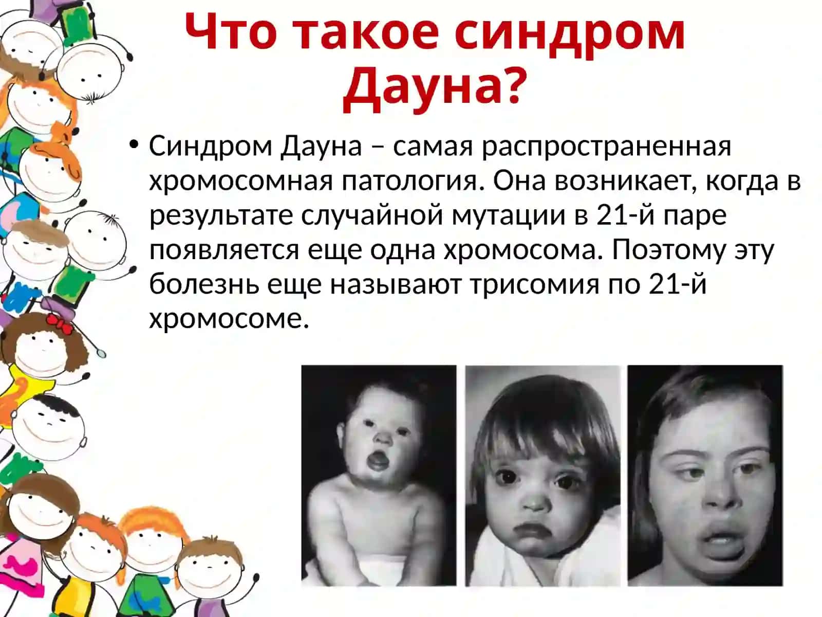 "Синдром Дауна - «Солнечные дети»" 4