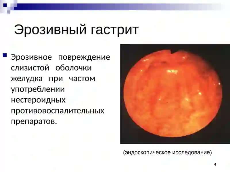 Гастрит, язвенная болезнь, аппендицит 4