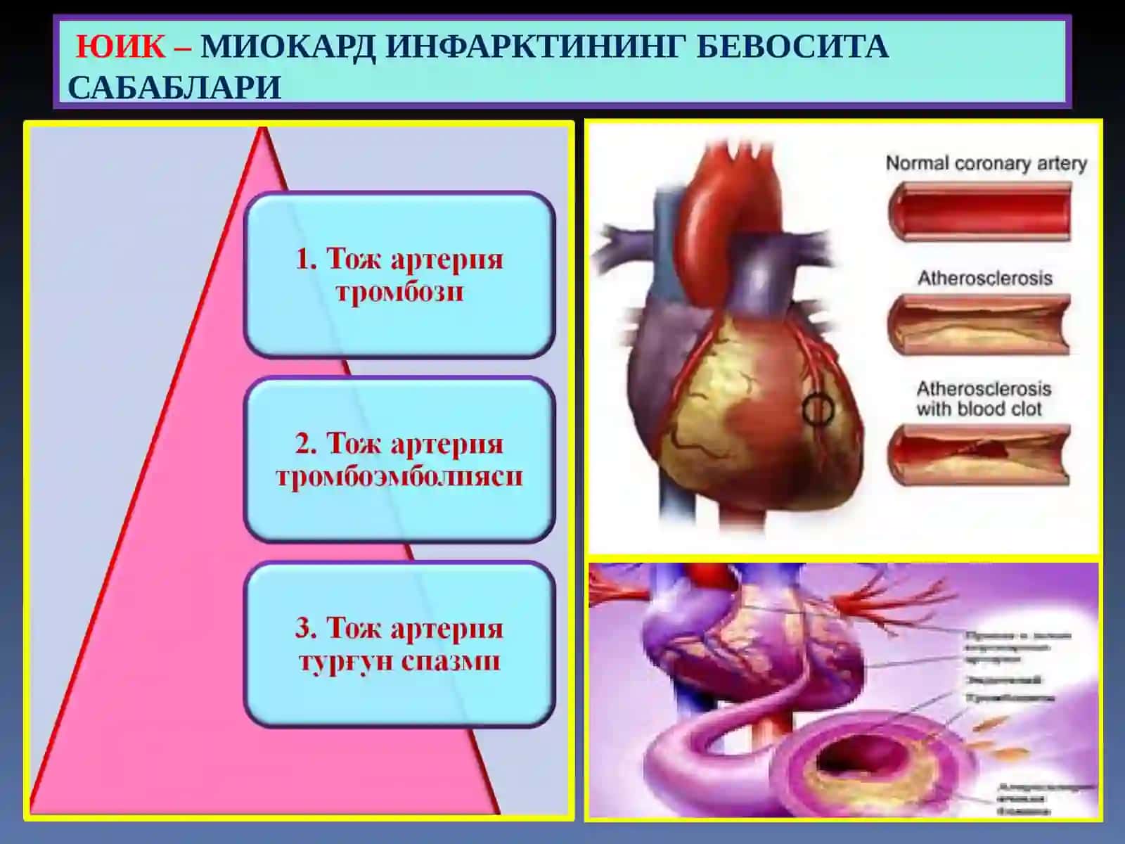 Юрак ишемик касаллиги 4